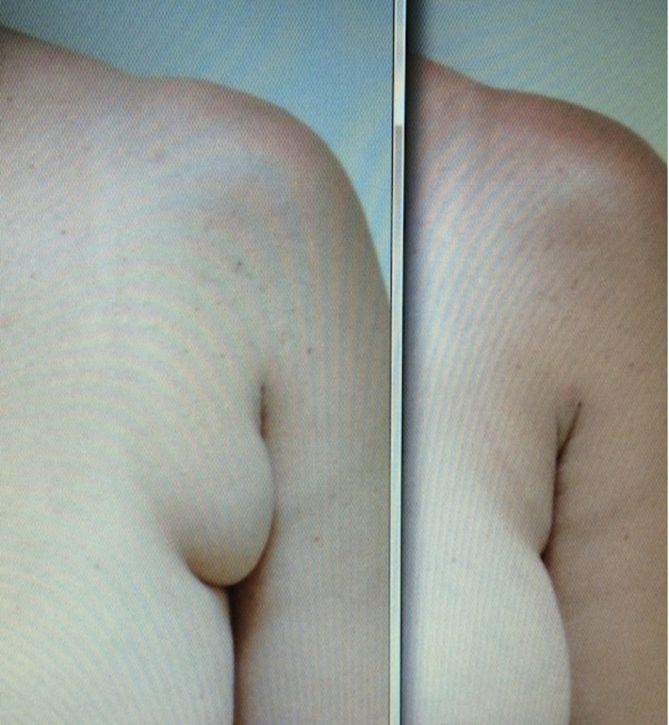 External Ultrasound Assisted Liposuction and Smart Lipo MPX of Axilla